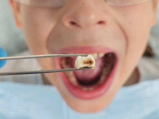 Best Emergency Broken Tooth Repair in Port Sulphur, LA